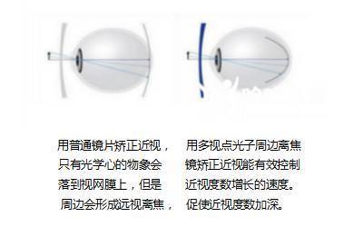 孩子眼睛度數(shù)持續(xù)加深？光學(xué)鏡片選擇與科學(xué)防控是關(guān)鍵